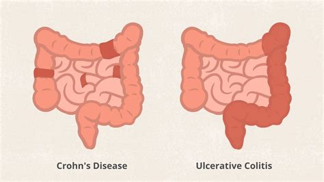 fucking sex|Crohns disease